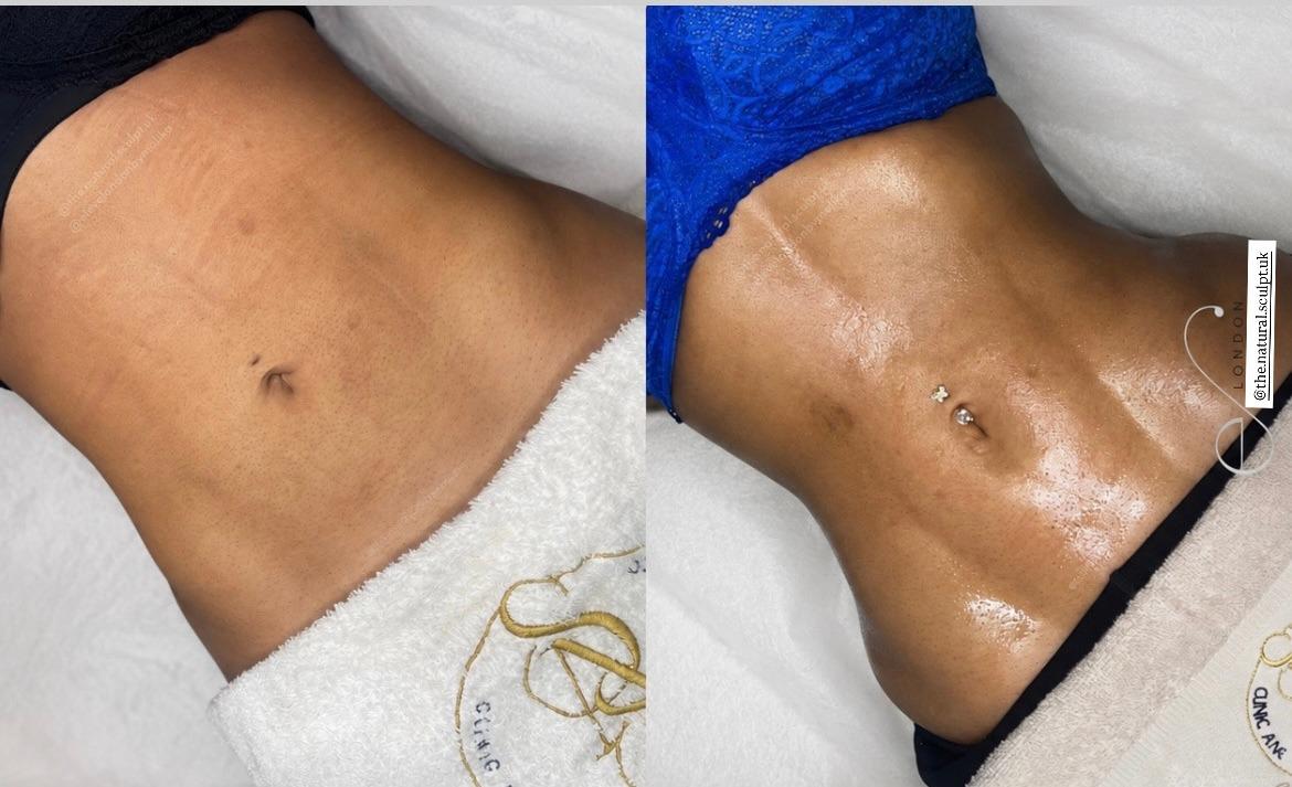 Before and after abdomen recovery at The Natural Sculpt, London