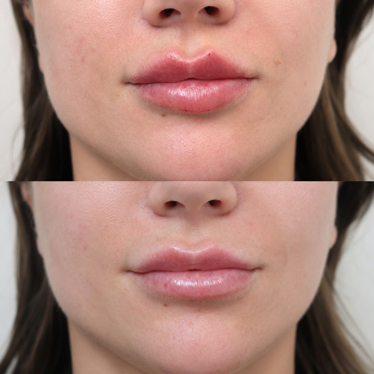 Lip Enhancement before and after at The Natural Sculpt, London